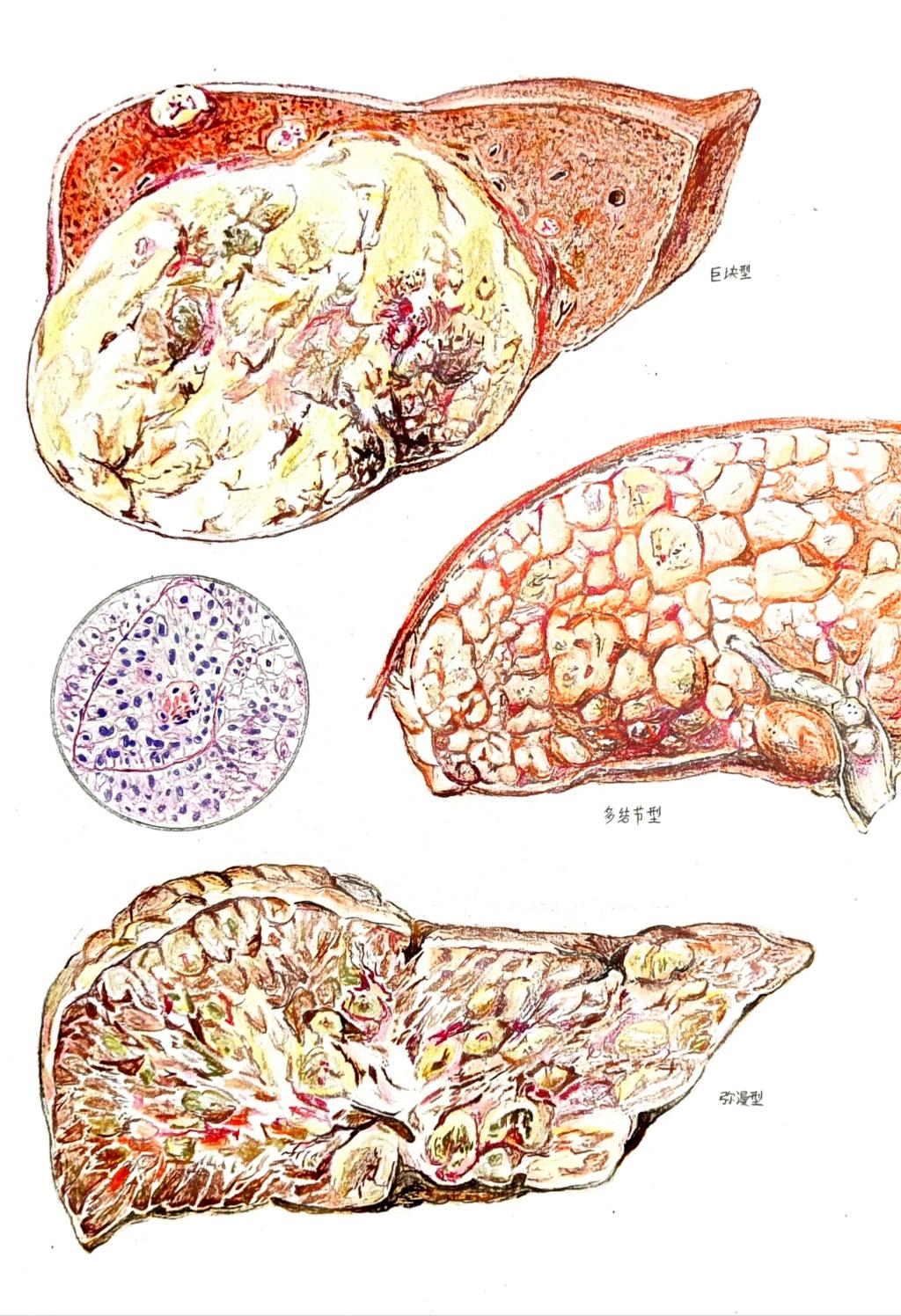5. 邮寄手绘 作品分类 2 肝细胞癌的病理变化 男同性恋av
 韩培航